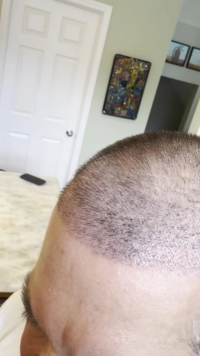 Clinicana Hair Transplant & Esthetic Surgeries Istanbul Turkey – Videolar · Kasimpaşa, İstanbul
