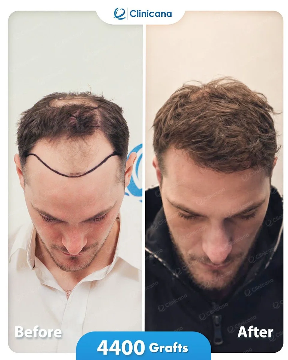Clinicana Hair Transplant & Esthetic Surgeries Istanbul Turkey – Profil fotoğrafı · Kasimpaşa, İstanbul